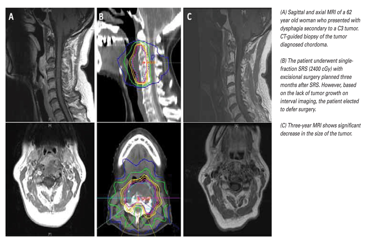 Treating Chordomas with Stereotactic Radiosurgery