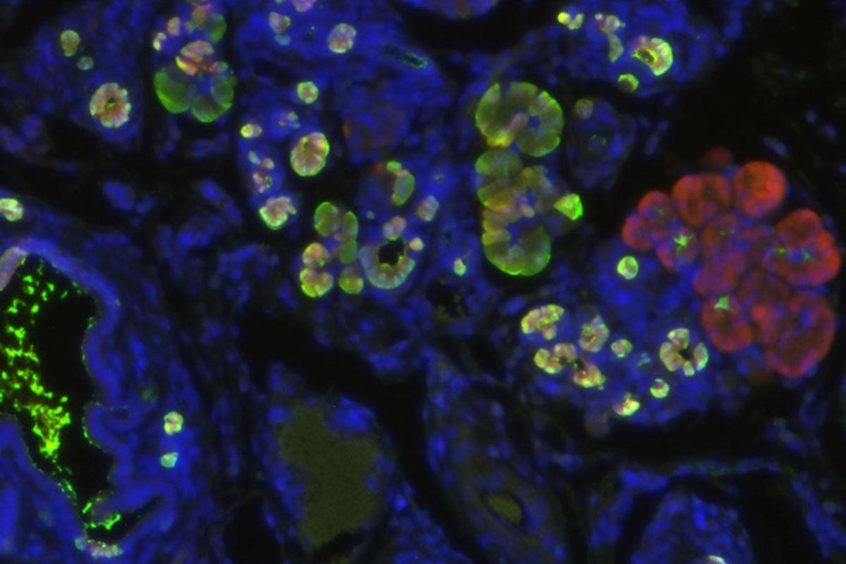 Fluorescence image of pancreatic cancer