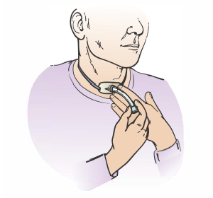 Figure 3. Sliding out the inner cannula
