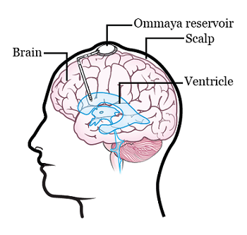 图 2. Ommaya 储液囊的放置