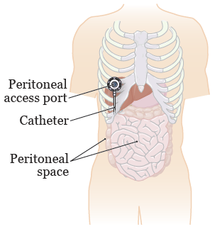 Figure 1. Your peritoneal space