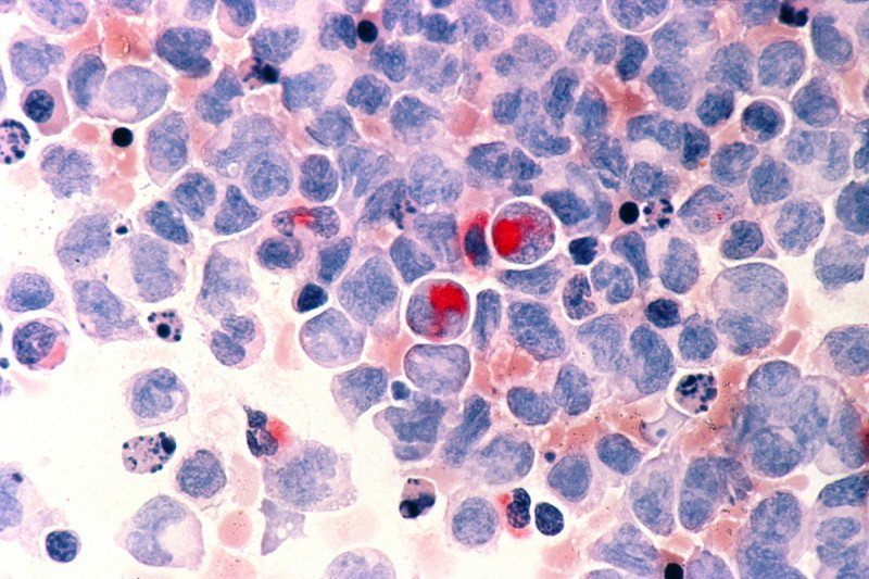 Light micrograph of white blood cells from a patient with acute myeloid leukemia.