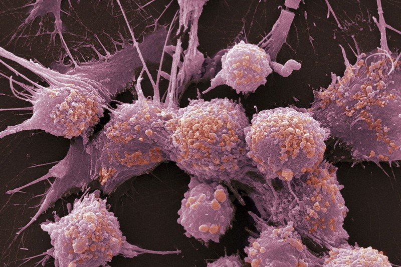 Prostate cancer cells, colored red in scanning electron micrograph (SEM).