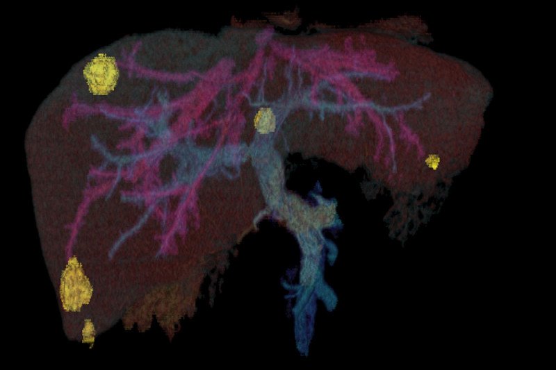 A color image of a liver with metastatic tumors